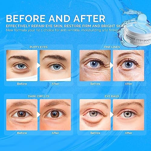 Comparison of eyes before and after treatment for puffy eyes, fine lines, dark circles, and eye bags.