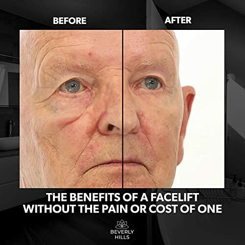 Before and after comparison of facelift treatment on an elderly person.